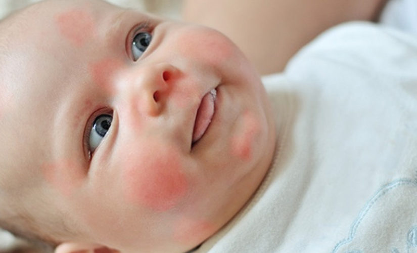 Como identificar alergia em bebês?