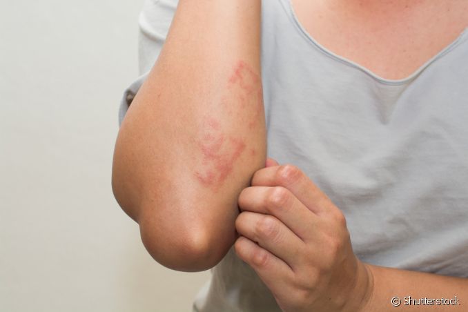 Micose ou alergia na pele: saiba como diferenciar