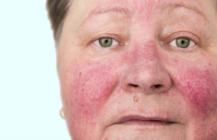 Rosácea ou alergia: saiba como identificar